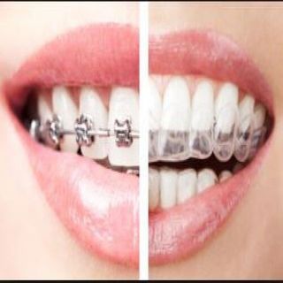 Anesthetic — Completed Teeth Brace in Tampa, FL