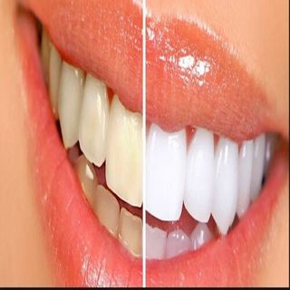 Canine — Before and After Teeth Whitening in Tampa, FL