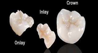 Porcelain restoration — Parts of a Tooth  in Tampa, FL