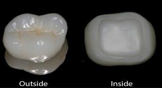Tooth Restoration — Outside and Insite of a Restored Tooth in Tampa, FL