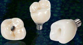 implant crowns — Dental implants in Tampa, FL