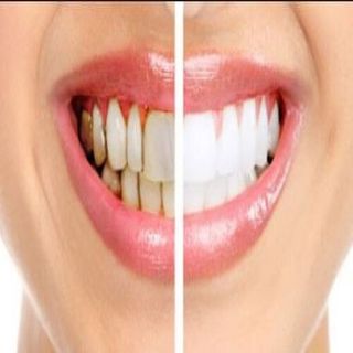 Cavity — Before and After of Teeth with Cavity in Tampa, FL