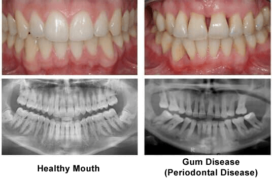 General Care — Before and After of Periodontal Disease Treatment with Xray Results in Tampa, FL General Care — Before and After of Periodontal Disease Treatment with Xray Results in Tampa, FL
