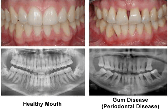 General Care — Before and After of Periodontal Disease Treatment with Xray Results in Tampa, FL