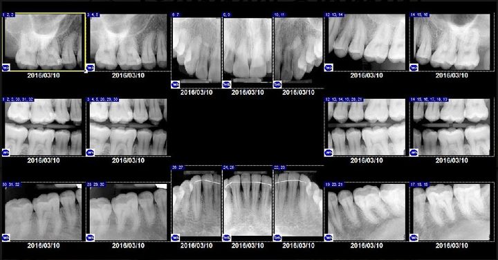 Full mouth x-rays — Dentist in Tampa, FL