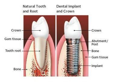 Dental implant — Dental implants in Tampa, FL