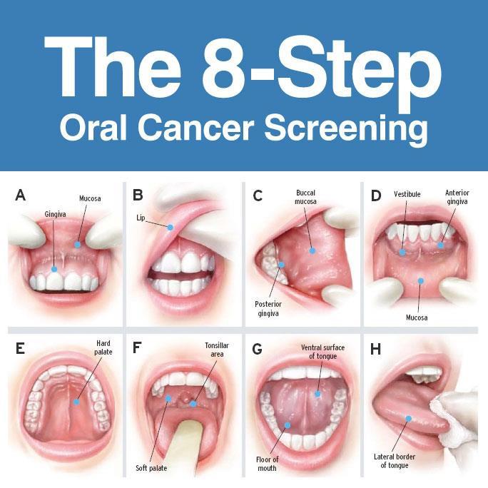 Oral cancer screening — Dentist in Tampa, FL