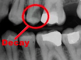 X-rays showing decay on a tooth — Dentist in Tampa, FL