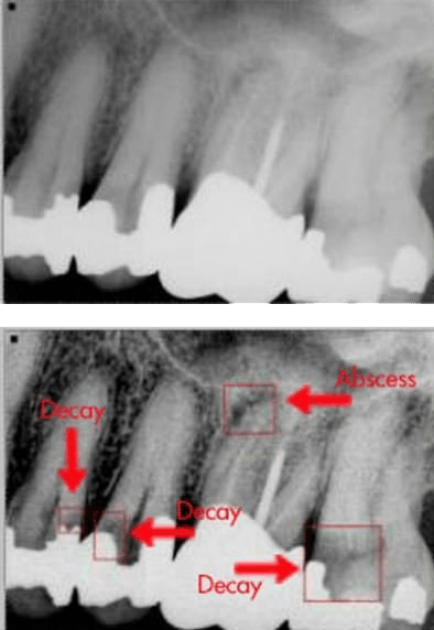 X-rays showing decay — Dentist in Tampa, FL