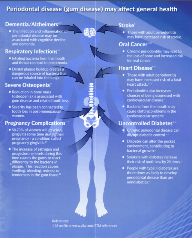 Periodontal disease affects — Dentist in Tampa, FL Periodontal disease affects — Dentist in Tampa, FL