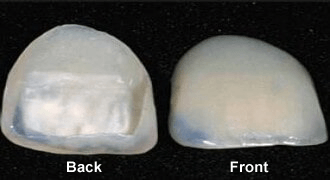 Invisalign Orthodontics — Porcelain Veneers in Tampa, FL