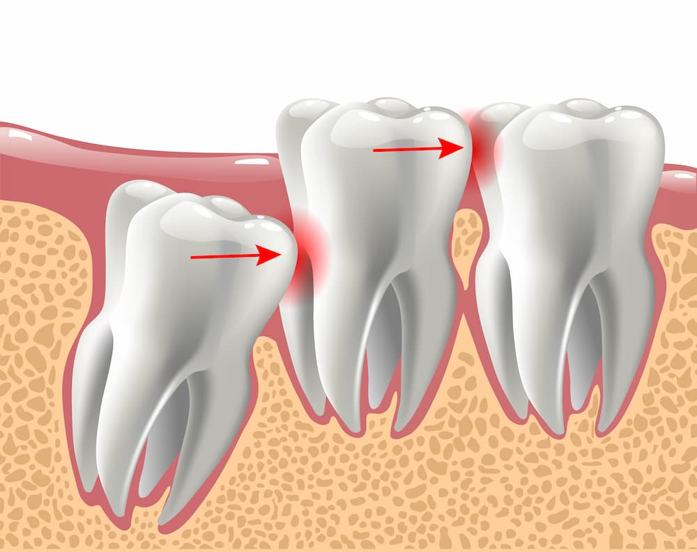 Misalignment Of Teeth — Dentists in Nelson Bay, NSW