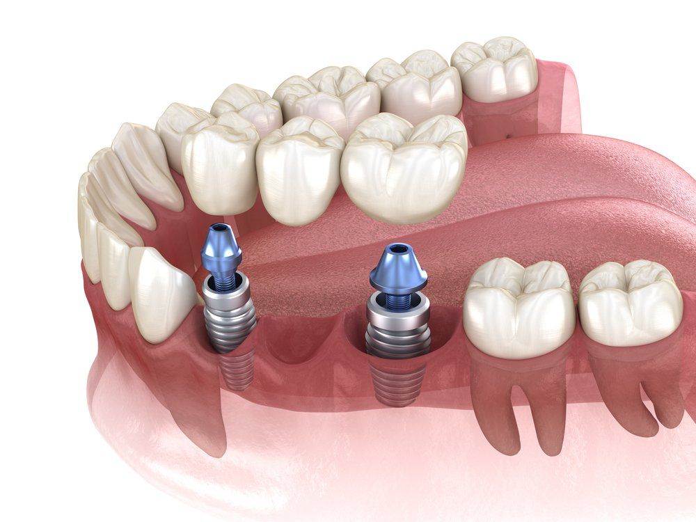 Adding Crowns To Abutments — Dentists in Nelson Bay, NSW