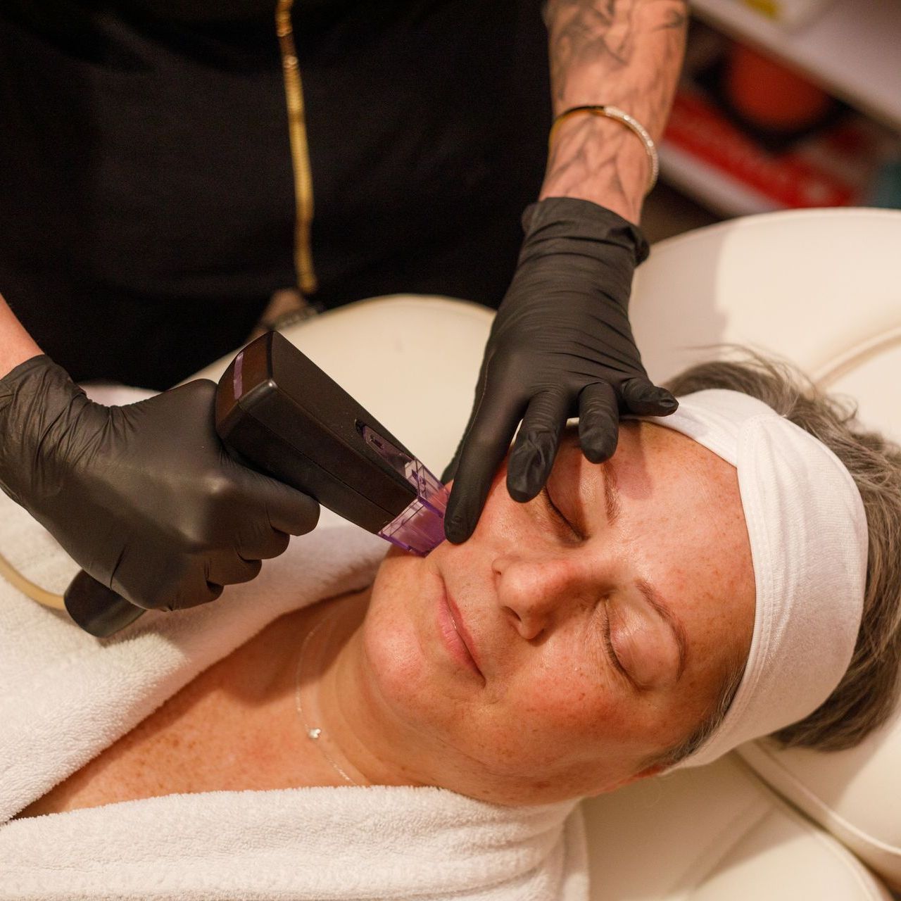 A woman receiving a Morpheus8 treatment