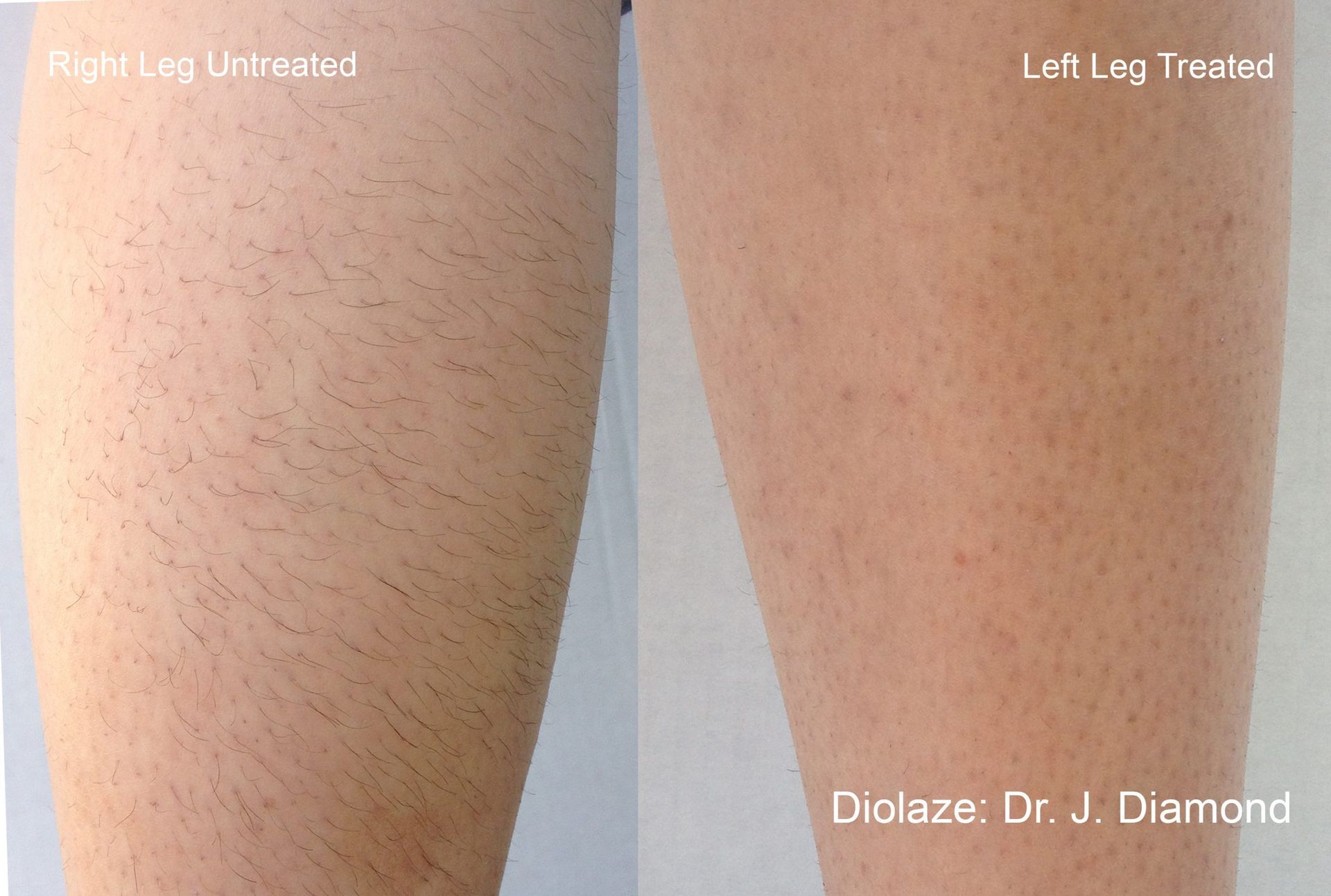 Legs before and after Diolaze treatment