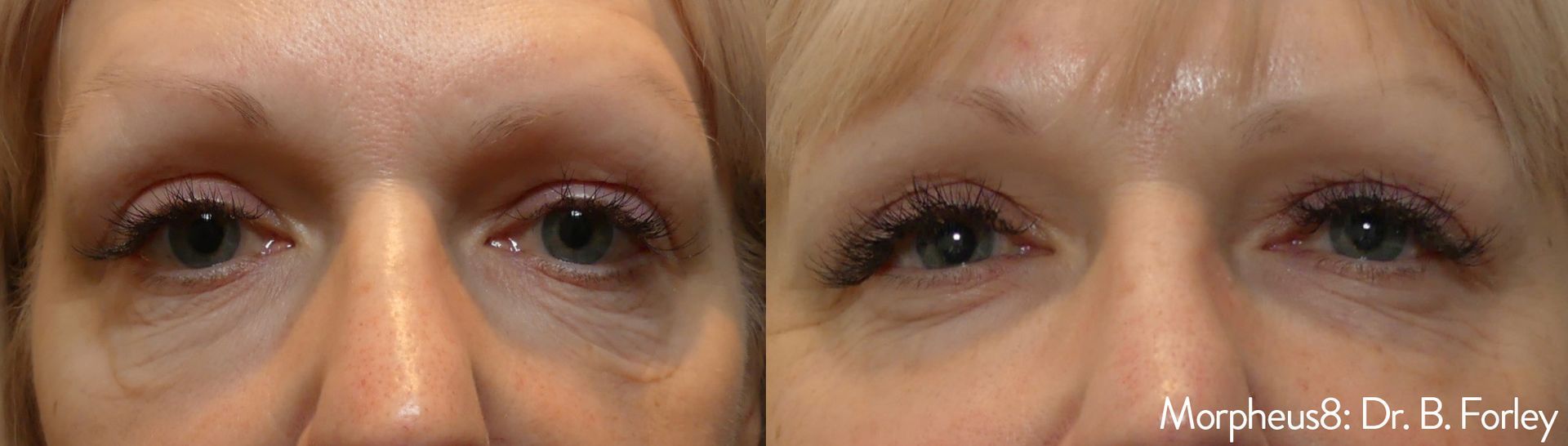 Under eye area before and after Morpheus8 treatments