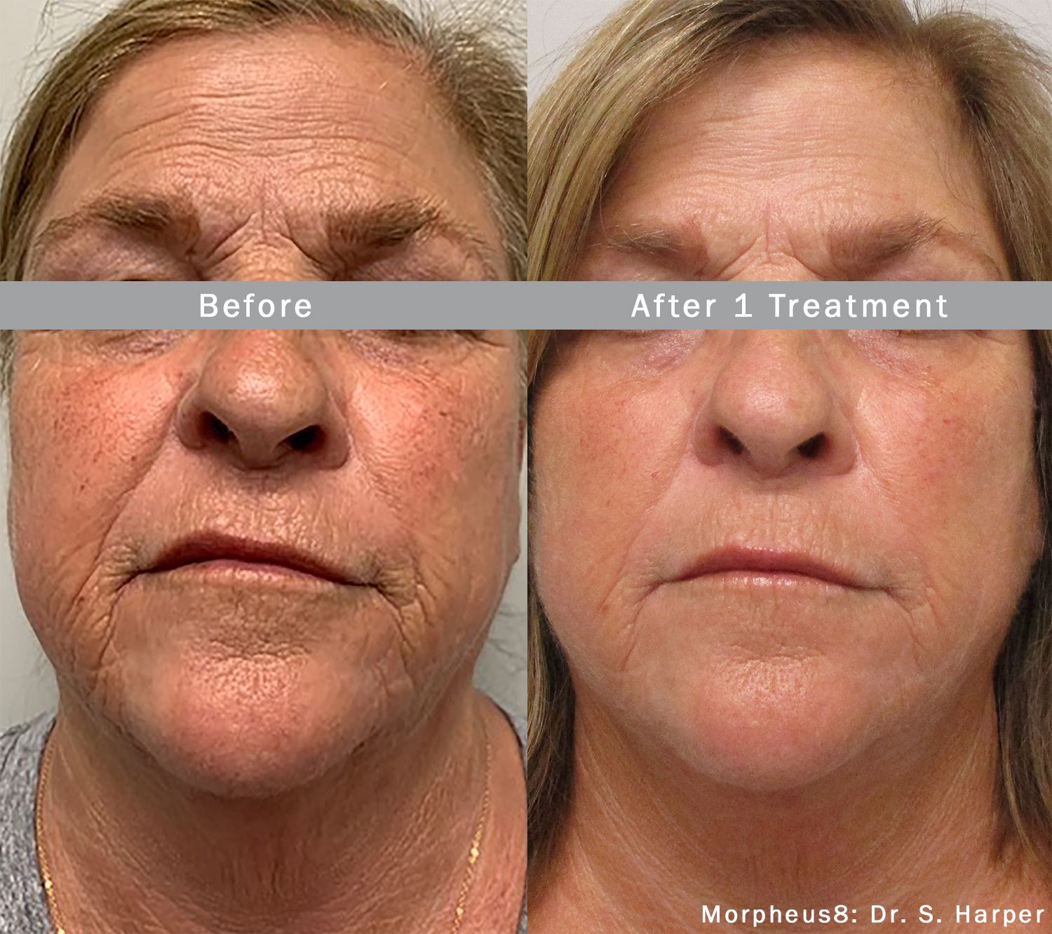 Face and Neck before and after Morpheus8 treatments