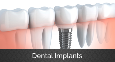 A dental implant is sitting in the middle of a row of teeth.