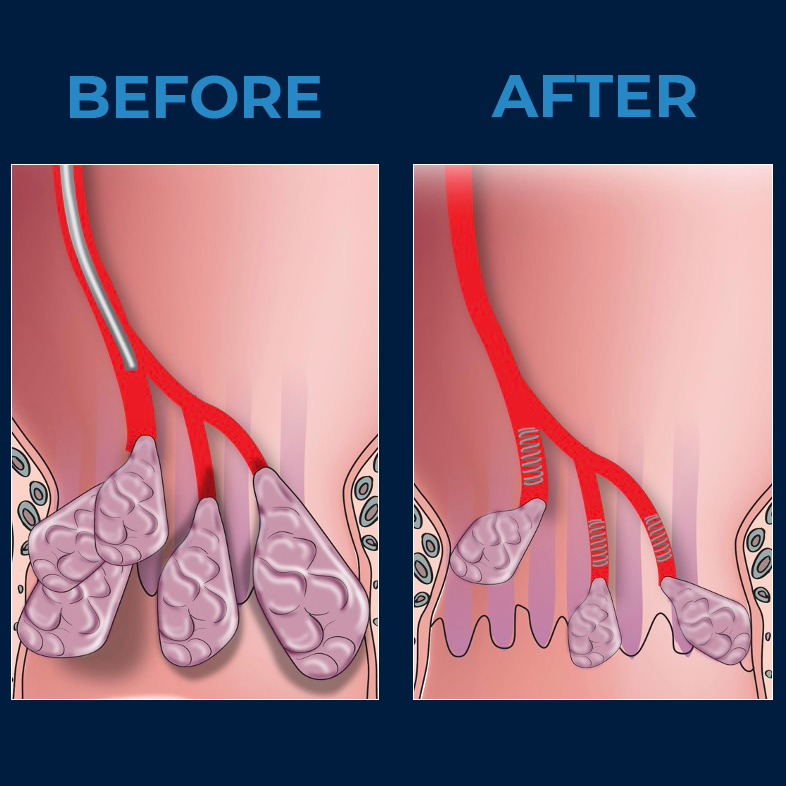 A before and after picture of a hemorrhoid