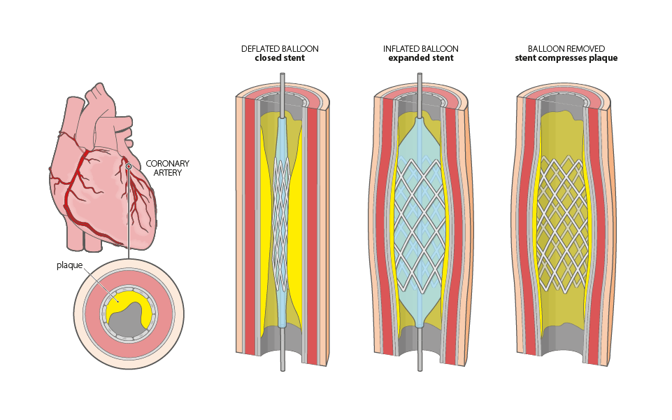 anatomy & physiology  illustration stent