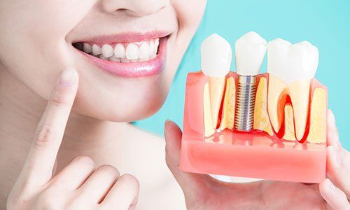 Dental Implants — Dentures in Hyannis and Woods Hole, MA