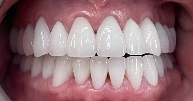 A close up of a person 's teeth with white teeth.