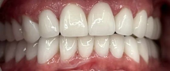 A close up of a person 's teeth with white teeth.