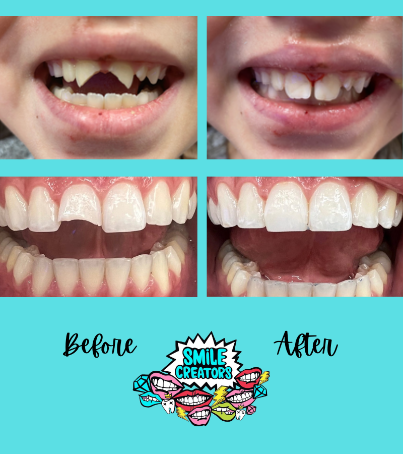 A before and after picture of a person 's teeth