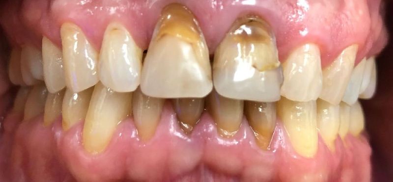A close up of a person 's teeth with brown spots on them.