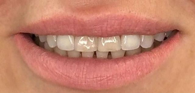 Smile Transformations | Smile Creators | Bay Harbor Islands, FL