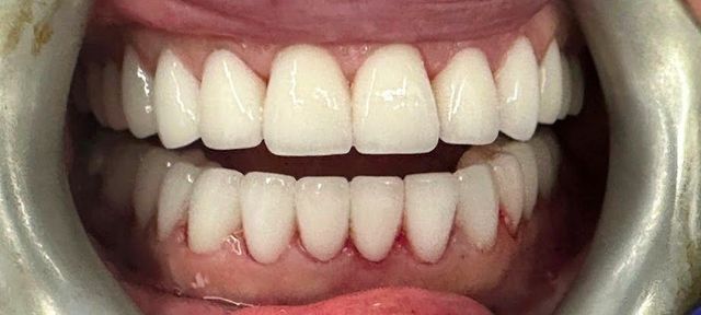 Smile Transformations | Smile Creators | Bay Harbor Islands, FL