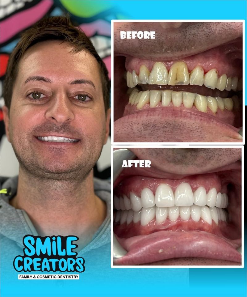 A before and after photo of a man 's teeth from smile creators