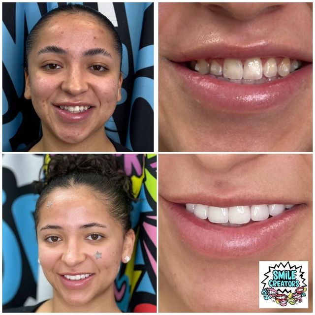 Dental Veneers In Bay Harbor Islands FL | Perfect Your Smile