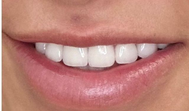 smile♡ Smile Transformations | Smile Creators | Bay Harbor Islands, FL