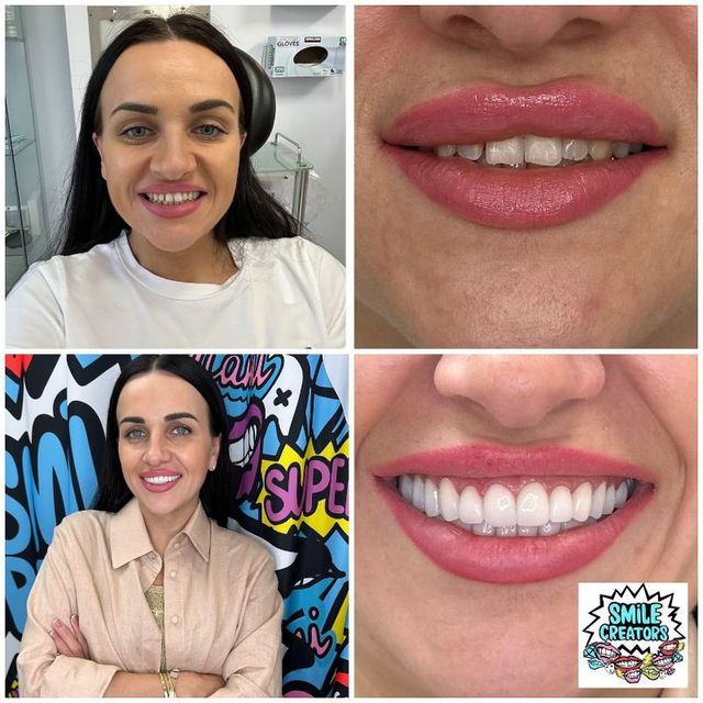 Dental Veneers In Bay Harbor Islands FL | Perfect Your Smile