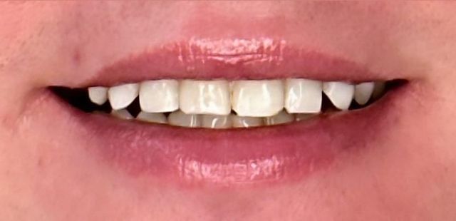 Smile Transformations | Smile Creators | Bay Harbor Islands, FL