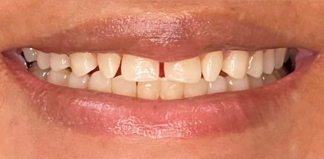Smile Transformations | Smile Creators | Bay Harbor Islands, FL