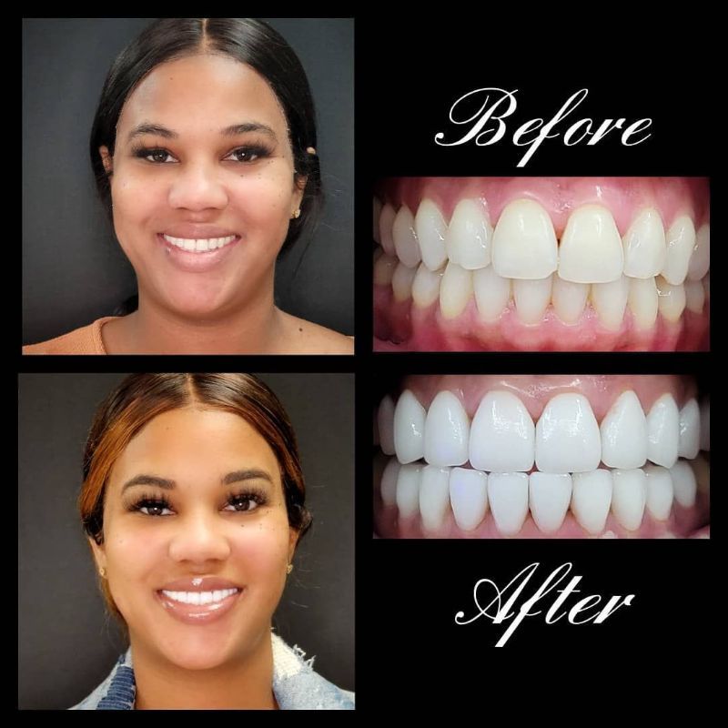 A before and after photo of a woman 's teeth