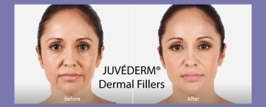 Juvéderm's Collection Of Fillers - Knoxville - Pure Luxe Fundamentals Explained thumbnail