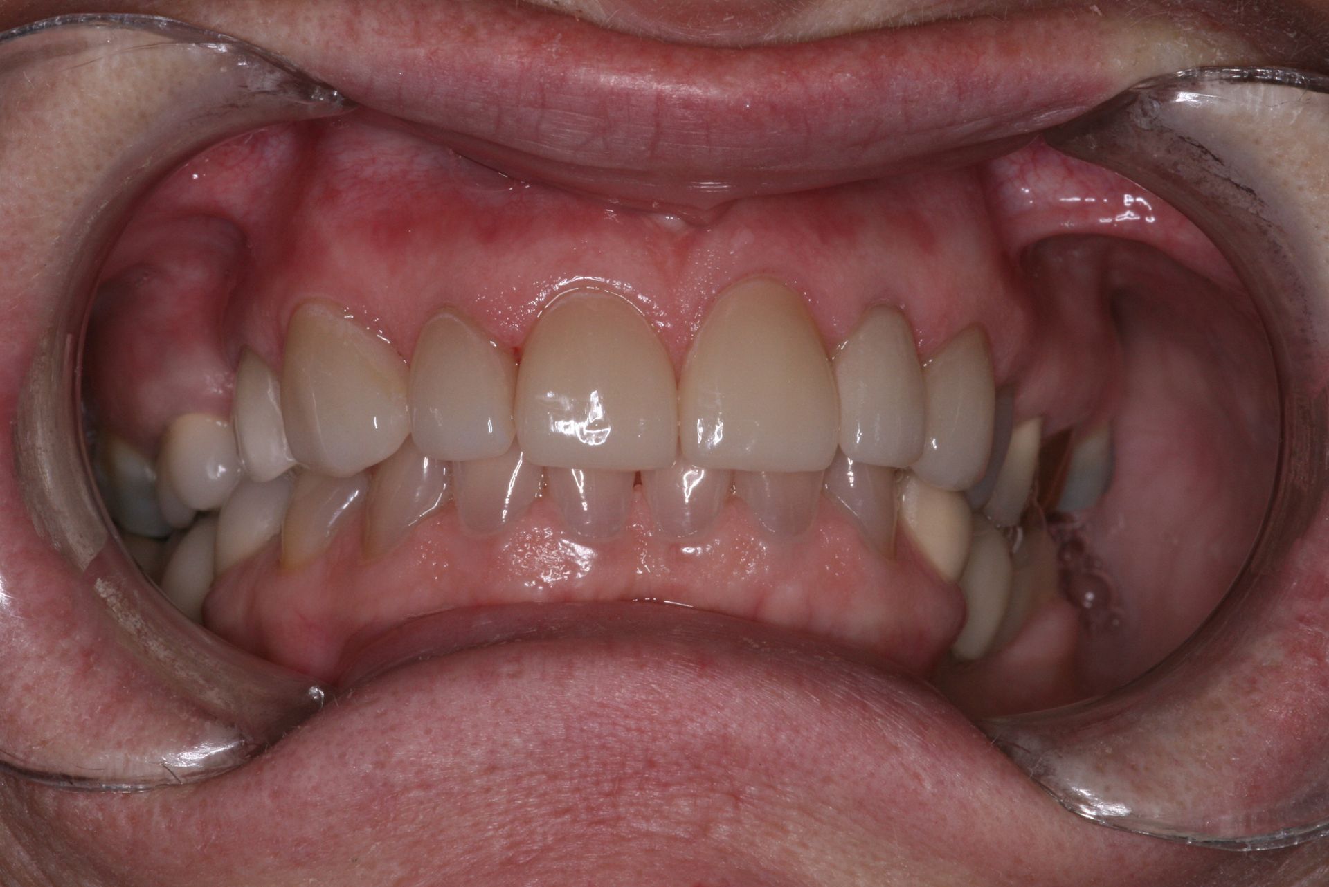 Close-up view of teeth and gums, light yellow teeth, pink gums.