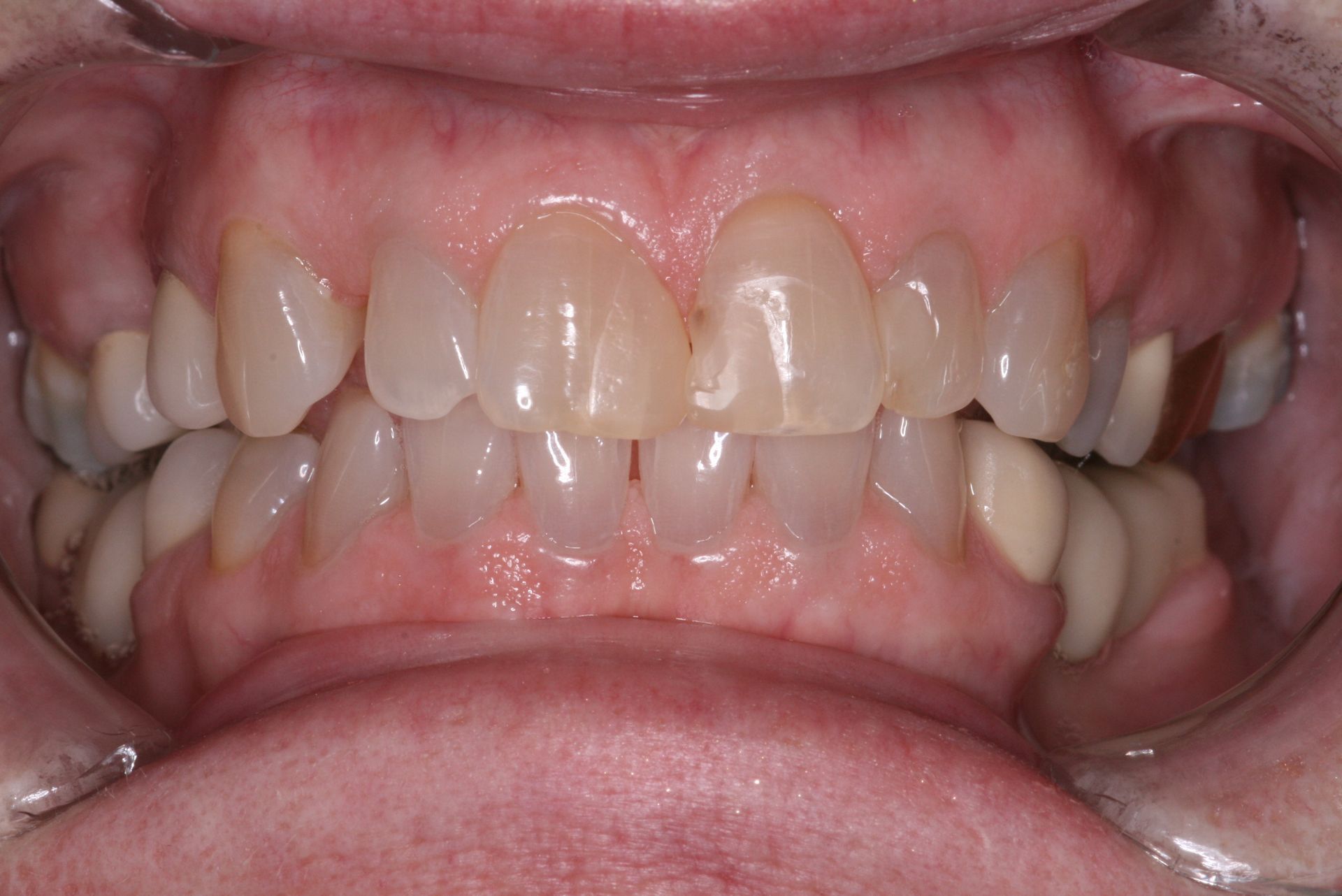 Close-up of human teeth, showing the upper and lower rows, slightly yellowed with a visible gum line.