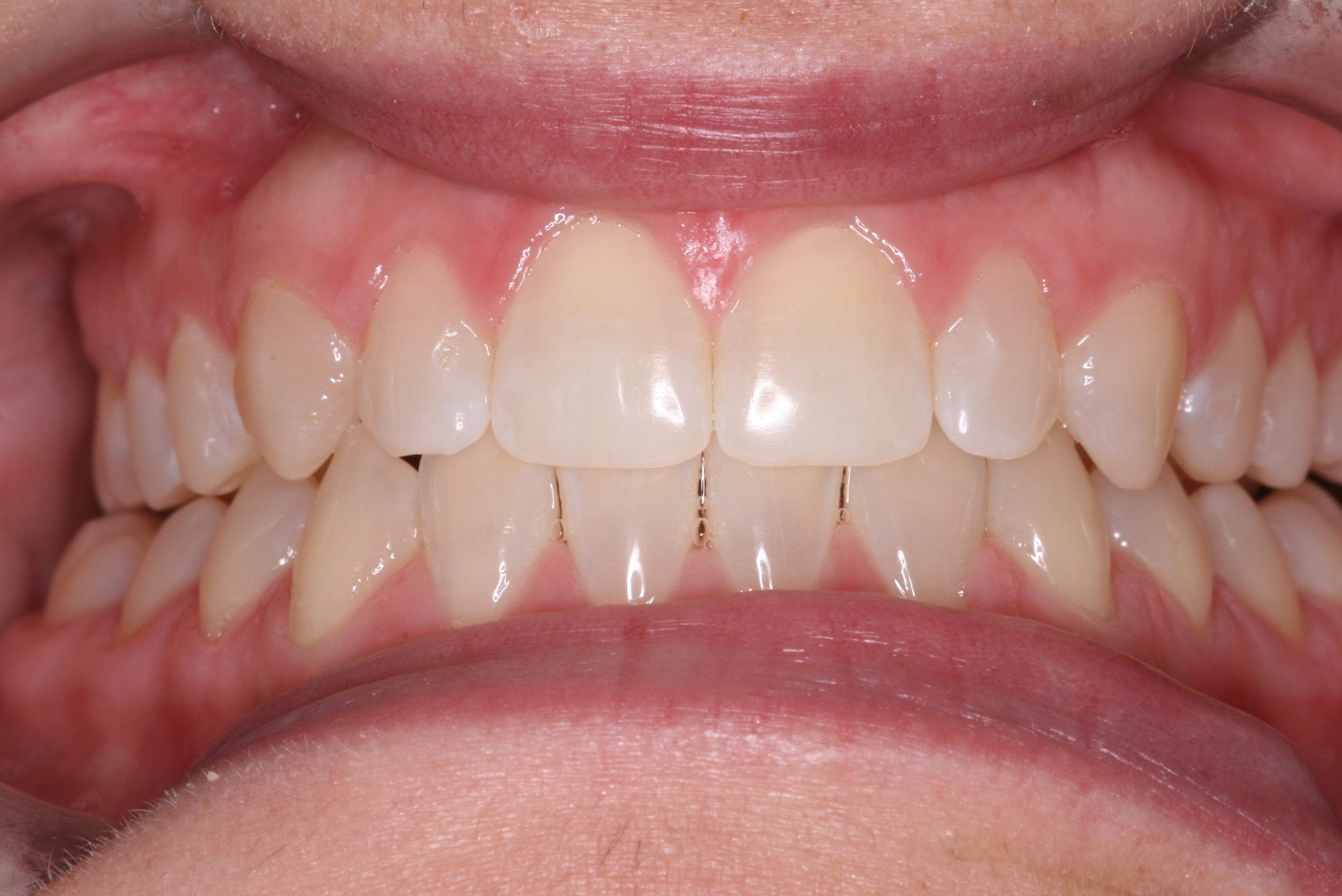 Close-up view of teeth and gums, light yellow teeth, pink gums.