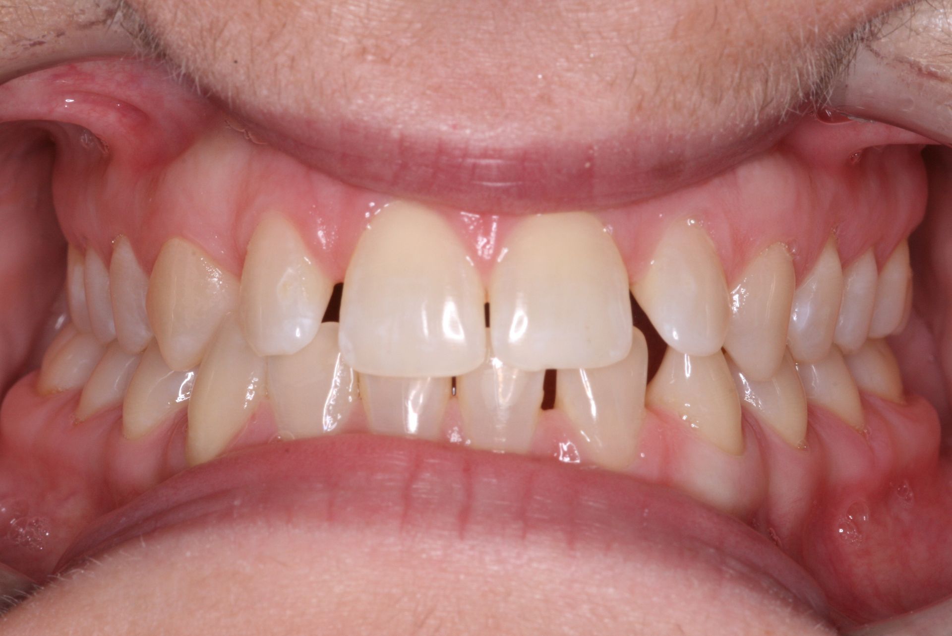 Close-up of human teeth, showing the upper and lower rows, slightly yellowed with a visible gum line.