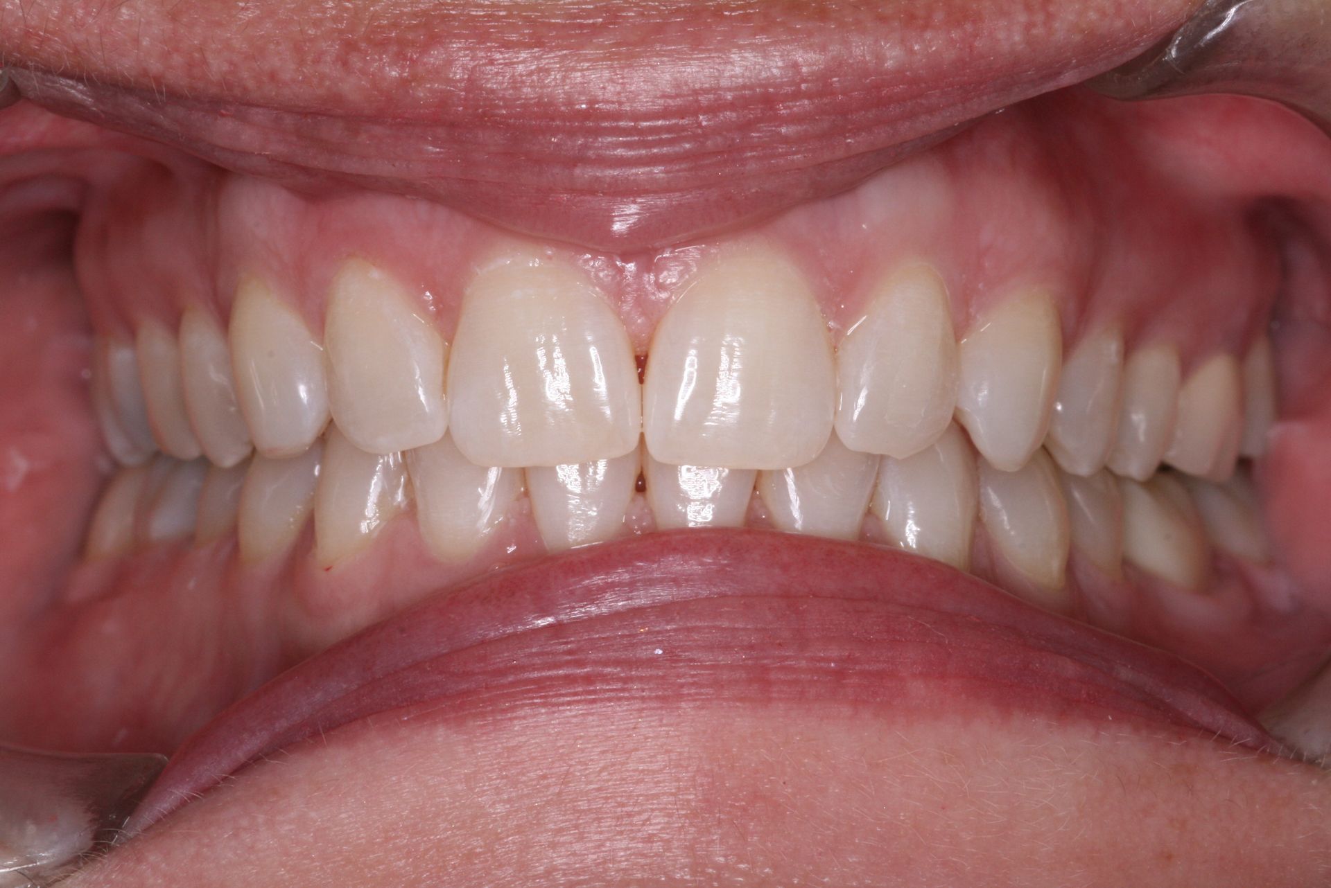 Close-up view of teeth and gums, light yellow teeth, pink gums.