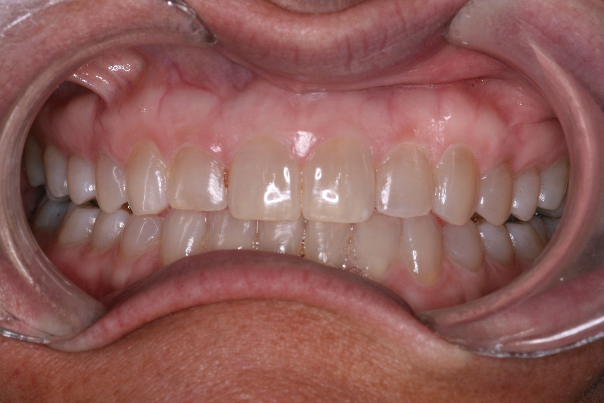 Close-up view of teeth and gums, light yellow teeth, pink gums.