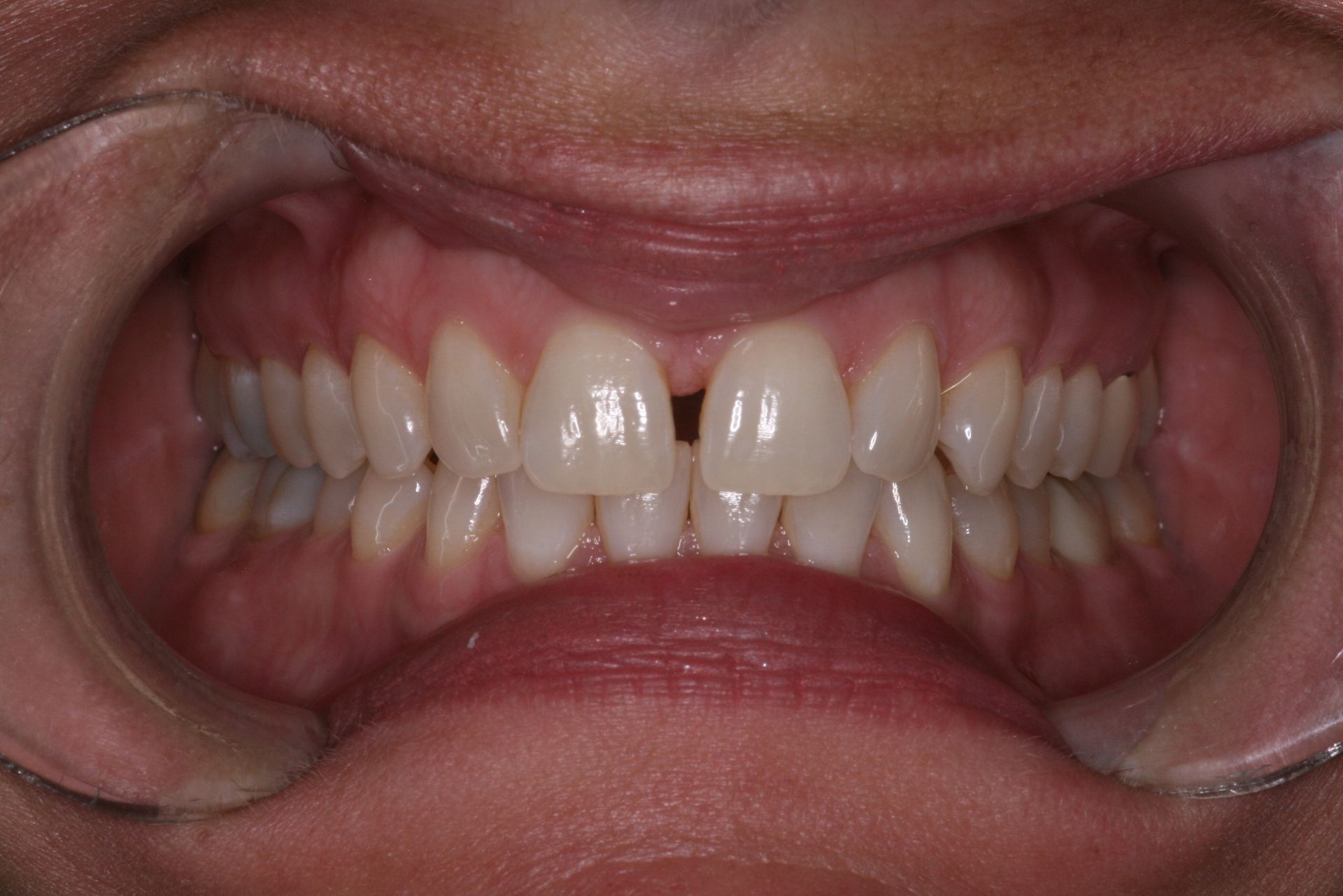 Close-up of human teeth, showing the upper and lower rows, slightly yellowed with a visible gum line.