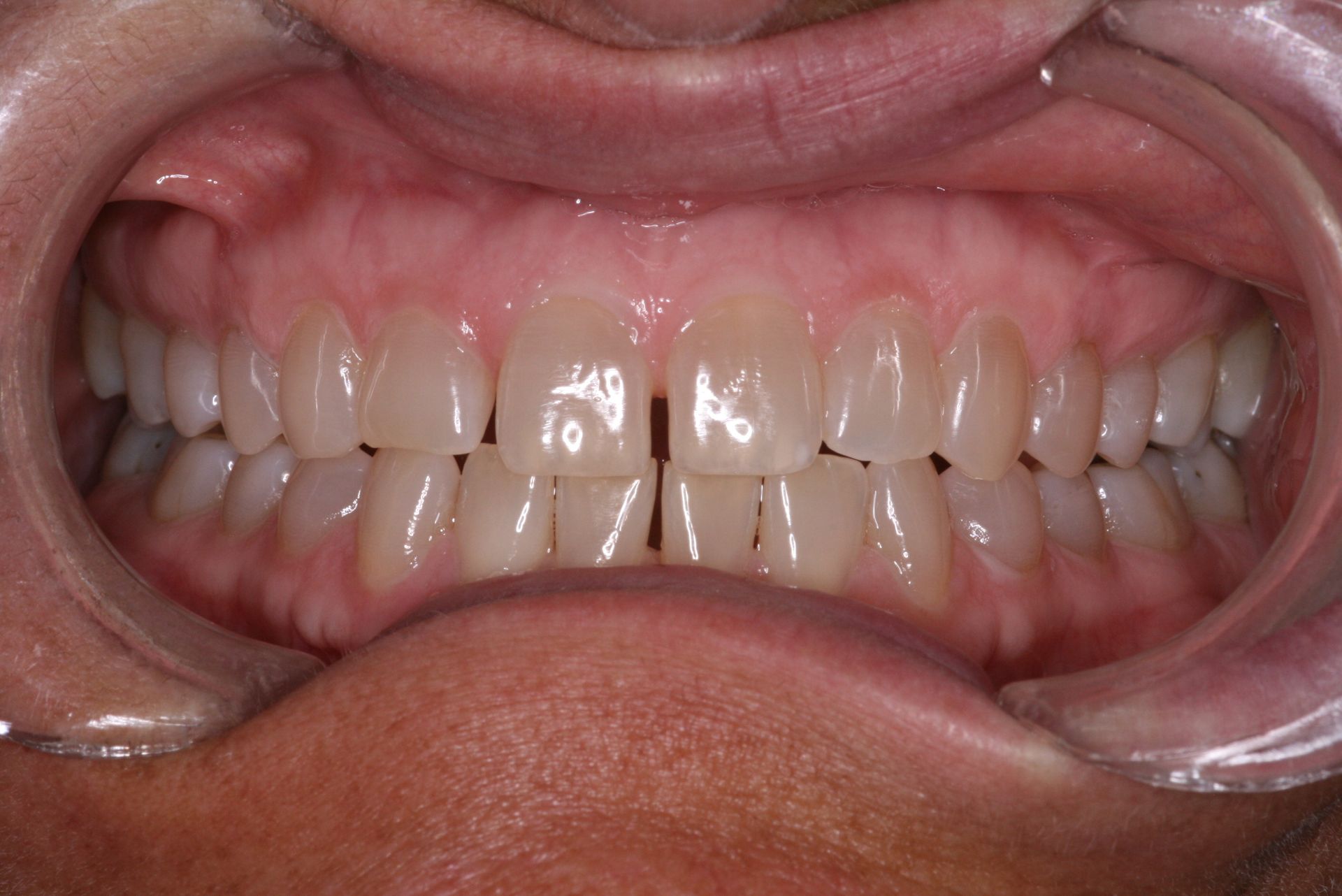 Close-up of human teeth, showing the upper and lower rows, slightly yellowed with a visible gum line.