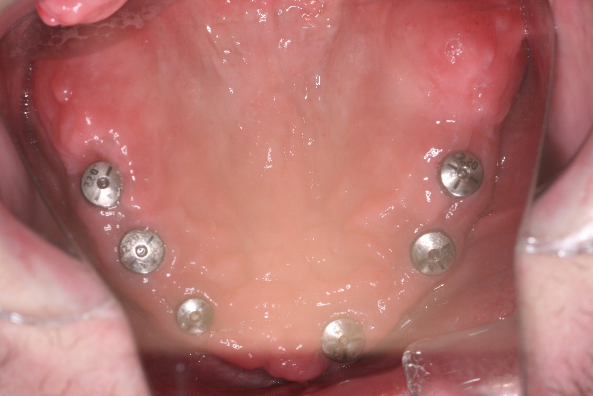 Close-up of human teeth, showing the upper and lower rows, slightly yellowed with a visible gum line.