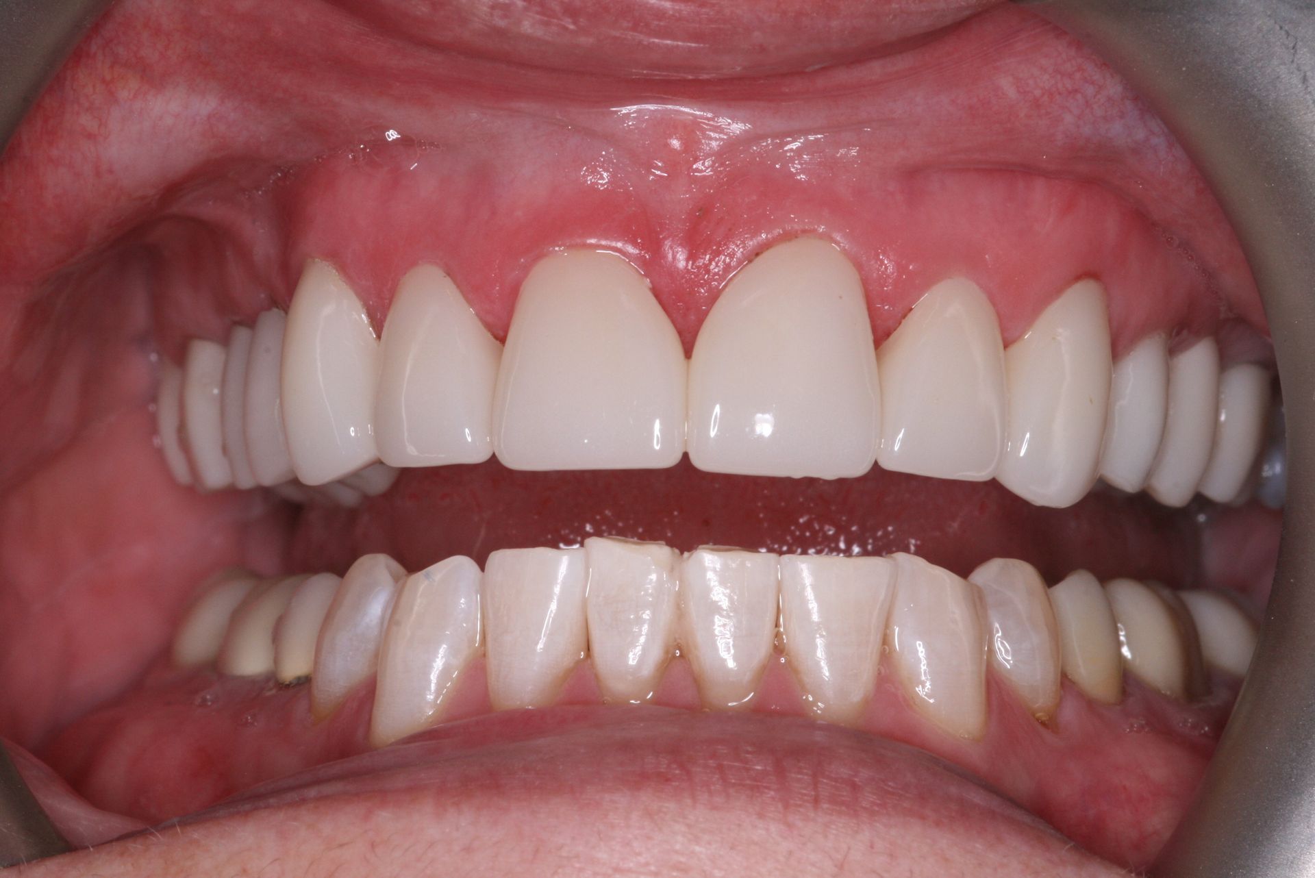 Close-up view of teeth and gums, light yellow teeth, pink gums.
