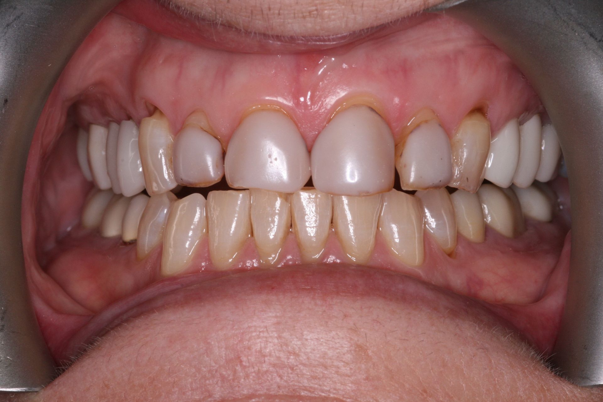 Close-up of human teeth, showing the upper and lower rows, slightly yellowed with a visible gum line.